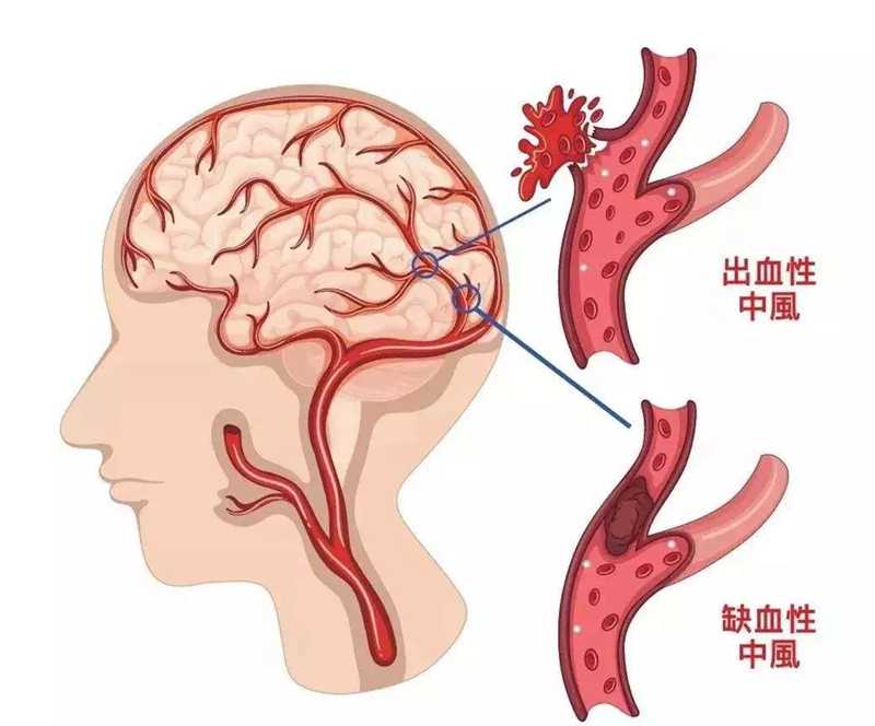 會(huì)不會(huì)得腦梗，你只需要做兩個(gè)檢查就可以知道！