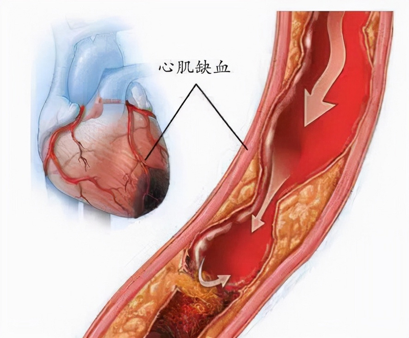 什么是心肌缺血？有5種情況不算是心肌缺血，不要自我恐慌！