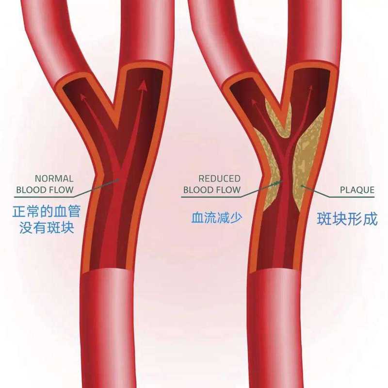 發(fā)現(xiàn)頸動(dòng)脈斑塊別恐慌，對(duì)癥治療更重要！