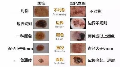 一文讀懂黑色素瘤和正常黑痣的區(qū)別！