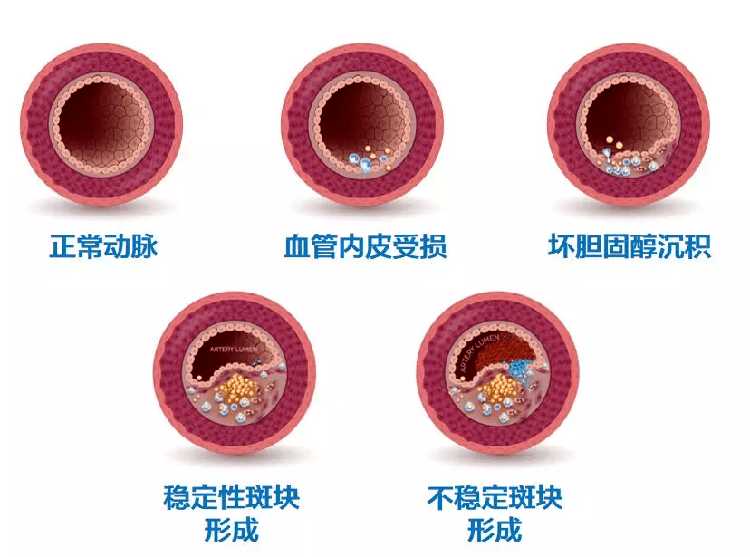 血管硬化不可逆，預(yù)防血管硬化需要注意以下事項！