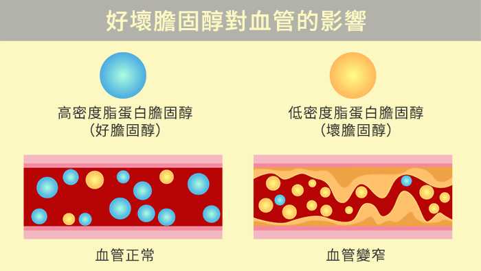 低密度脂蛋白膽固醇是心梗腦梗幫兇，它升高了怎么辦？