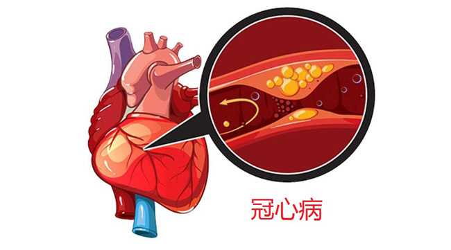 什么是冠心病，你為什么會(huì)得冠心病？