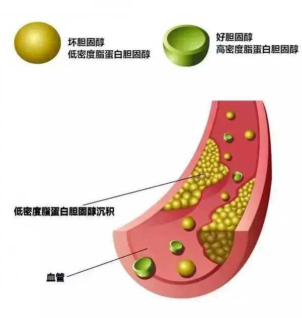 低密度脂蛋白膽固醇是心梗腦梗幫兇，它升高了怎么辦？