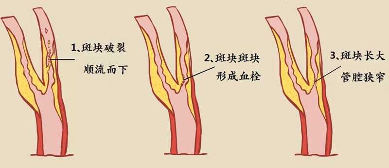 頸動(dòng)脈斑塊脫落有哪些先兆？