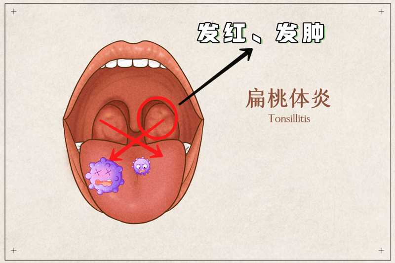 扁桃體炎