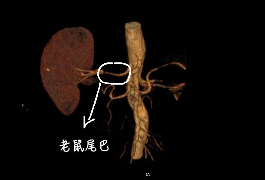 男人腎不行，更容易得高血壓！關(guān)注腎血管性高血壓癥