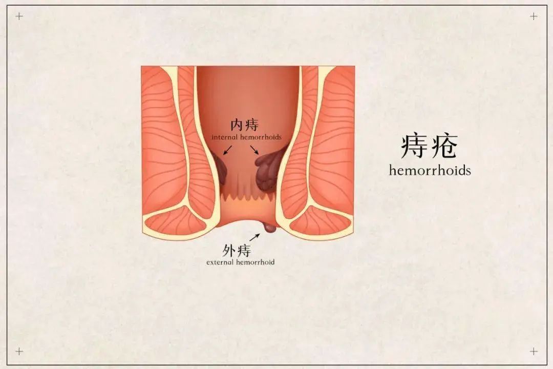 如何判斷自己是否得了痔瘡？得了痔瘡有什么癥狀