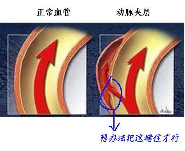 男人腎不行，更容易得高血壓！關(guān)注腎血管性高血壓癥