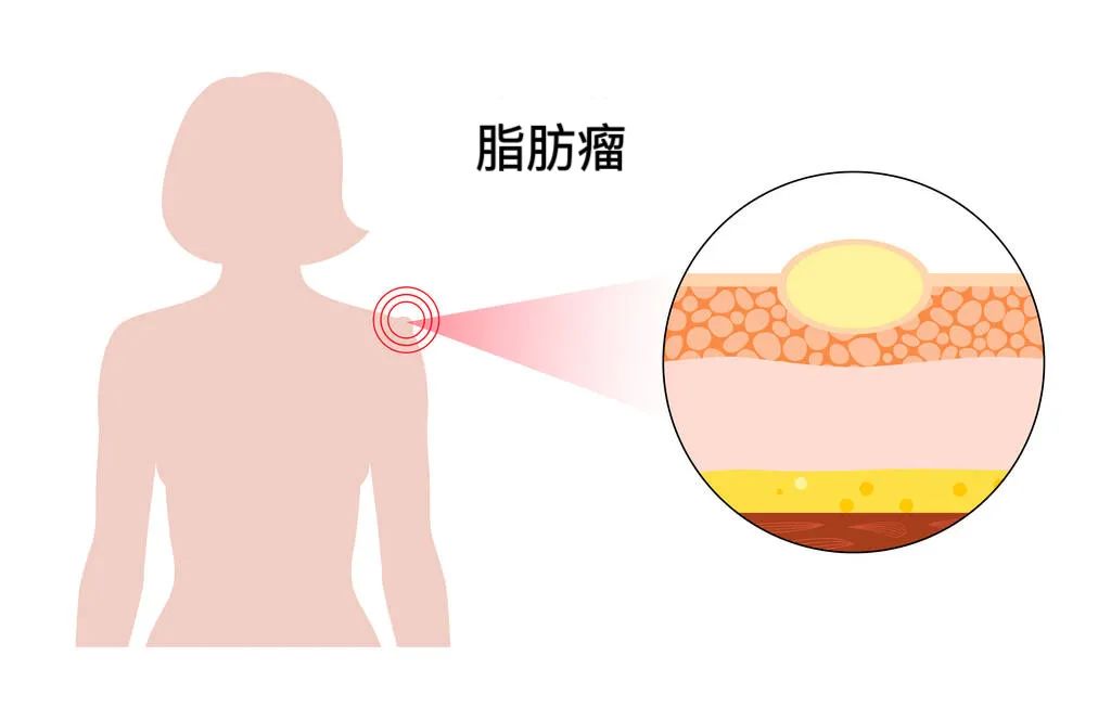 脂肪瘤不痛不癢，需要治療嗎？脂肪瘤怎么治療最好？