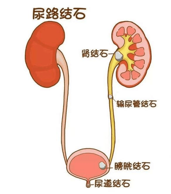 得了腎結(jié)石怎么辦！哪些藥物能夠治療和預(yù)防腎結(jié)石？