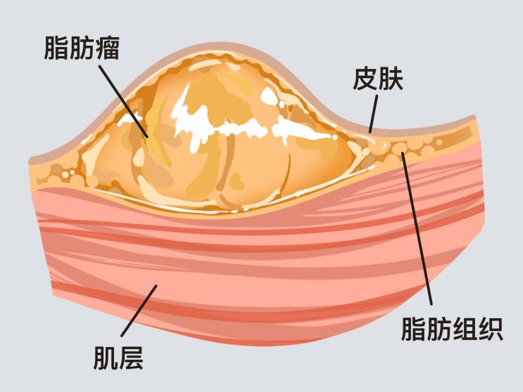 脂肪瘤不痛不癢，需要治療嗎？脂肪瘤怎么治療最好？