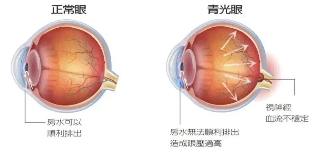 淺談全飛秒激光近視手術(shù)