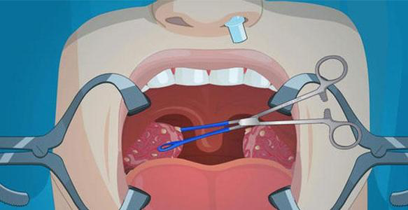 無(wú)法改善的口臭、咽喉痛，需要檢查一下你的扁桃體結(jié)石！