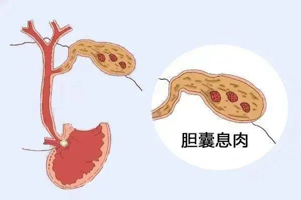 為什么會長膽囊息肉？體檢發(fā)現(xiàn)膽囊息肉該怎么辦？