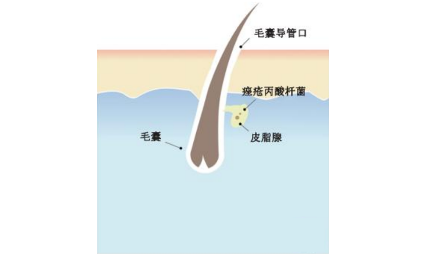 痤瘡治療需要對癥用藥，不同癥狀的痤瘡對應(yīng)的治療藥物匯總！