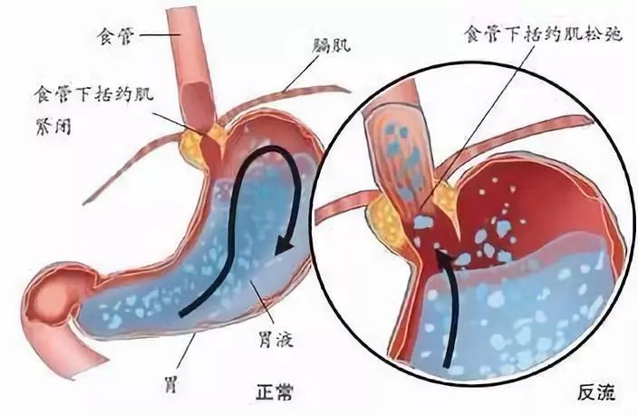 經(jīng)常反酸燒心，可能是什么??？