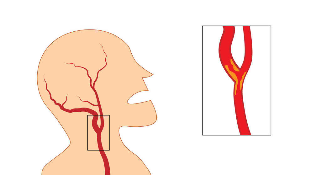 經(jīng)常眼前一黑，建議查查頸動脈，警惕高危心腦血管疾??！