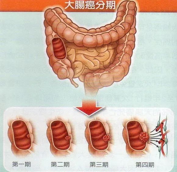 腸癌的早期癥狀有哪些？腸道息肉如何一步步演變成腸癌的？