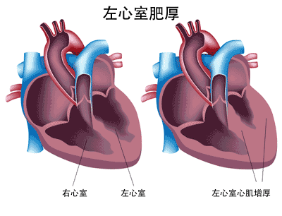 沒有任何癥狀的高血壓，需要治療嗎？