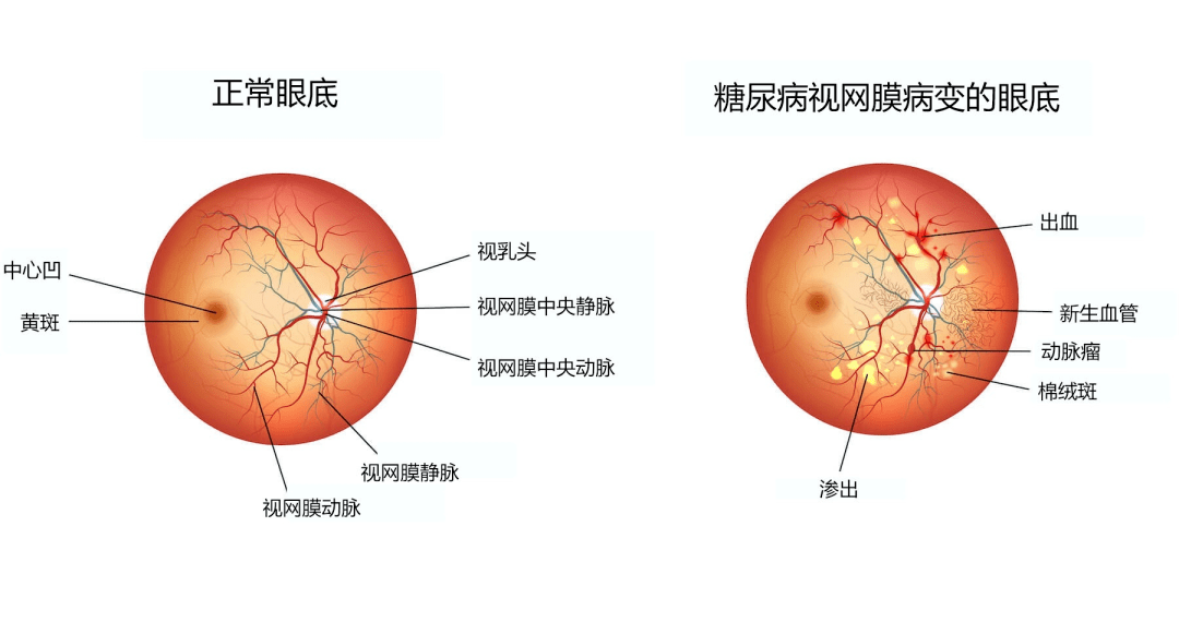 血糖控制不好，會(huì)對(duì)身體造成哪些危害？